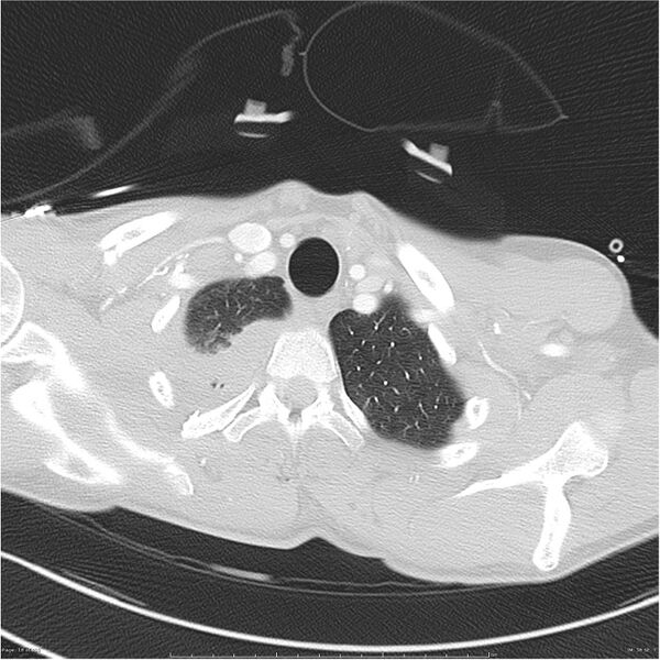File:Chest and abdomen multi-trauma (Radiopaedia 26294-26425 lung window 18).jpg