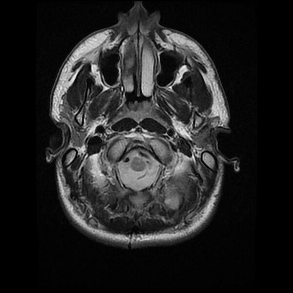 File:Chiasmatic-hypothalamic juvenile pilocytic astrocytoma (Radiopaedia 78533-91235 Axial T2 4).jpg