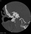 Cholesteatoma (Radiopaedia 5467-7197 Coronal bone window 18).jpg