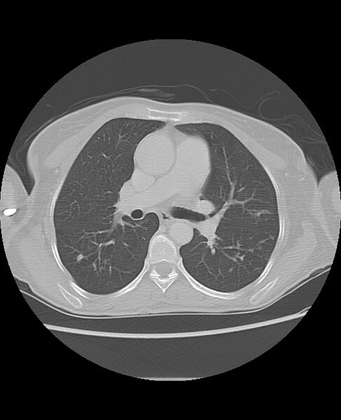 File:Chondrosarcoma (Radiopaedia 79427-92532 Axial lung window 26).jpg