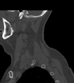 Chordoma (C4 vertebra) (Radiopaedia 47561-52188 Sagittal bone window 12).png