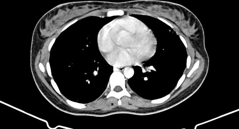 File:Choriocarcinoma liver metastases (Radiopaedia 74768-85766 A 6).jpg