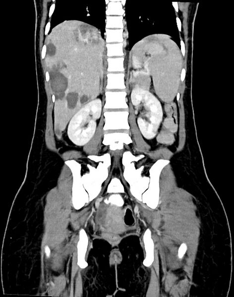 File:Choriocarcinoma liver metastases (Radiopaedia 74768-85766 B 68).jpg