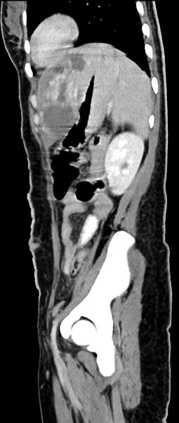 File:Choriocarcinoma liver metastases (Radiopaedia 74768-85766 C 66).jpg