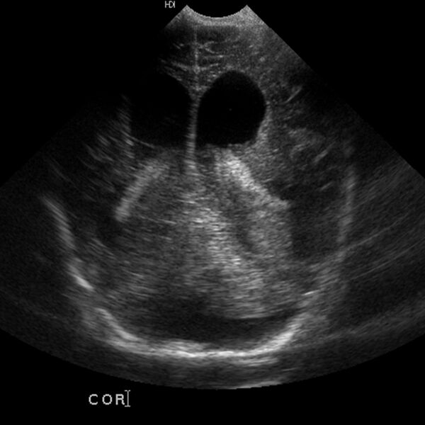 File:Choroid plexus carcinoma (Radiopaedia 21121-21033 A 17).jpg