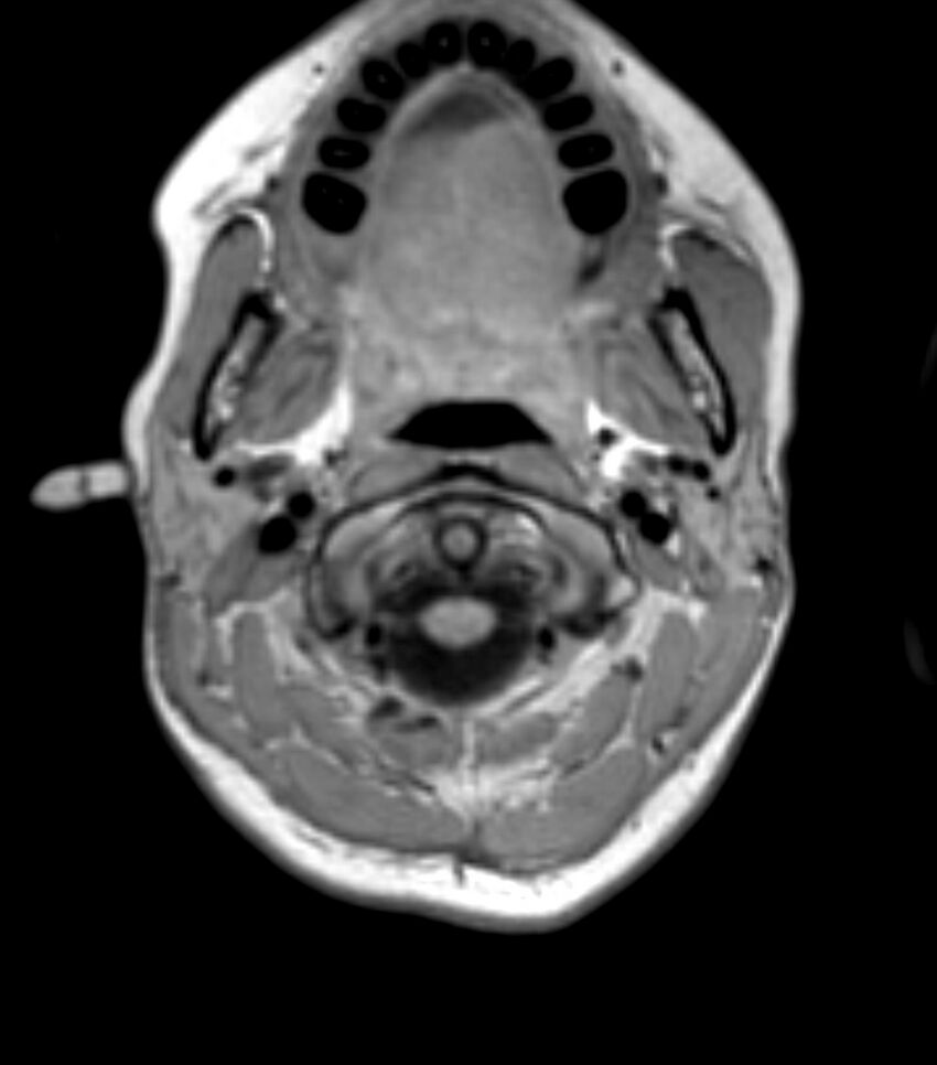 Choroid plexus carcinoma (Radiopaedia 91013-108553 Axial T1 20).jpg