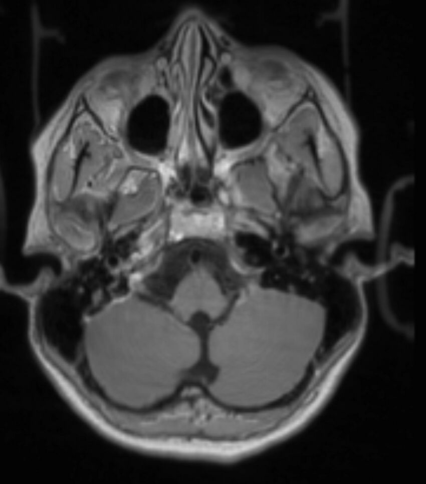 Choroid plexus carcinoma (Radiopaedia 91013-108553 Axial T1 C+ 88).jpg