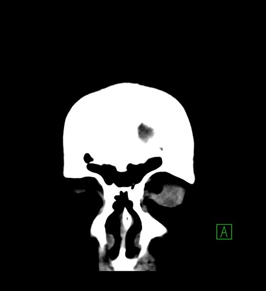 File:Choroid plexus xanthogranuloma (Radiopaedia 91271-108874 Coronal non-contrast 3).jpg