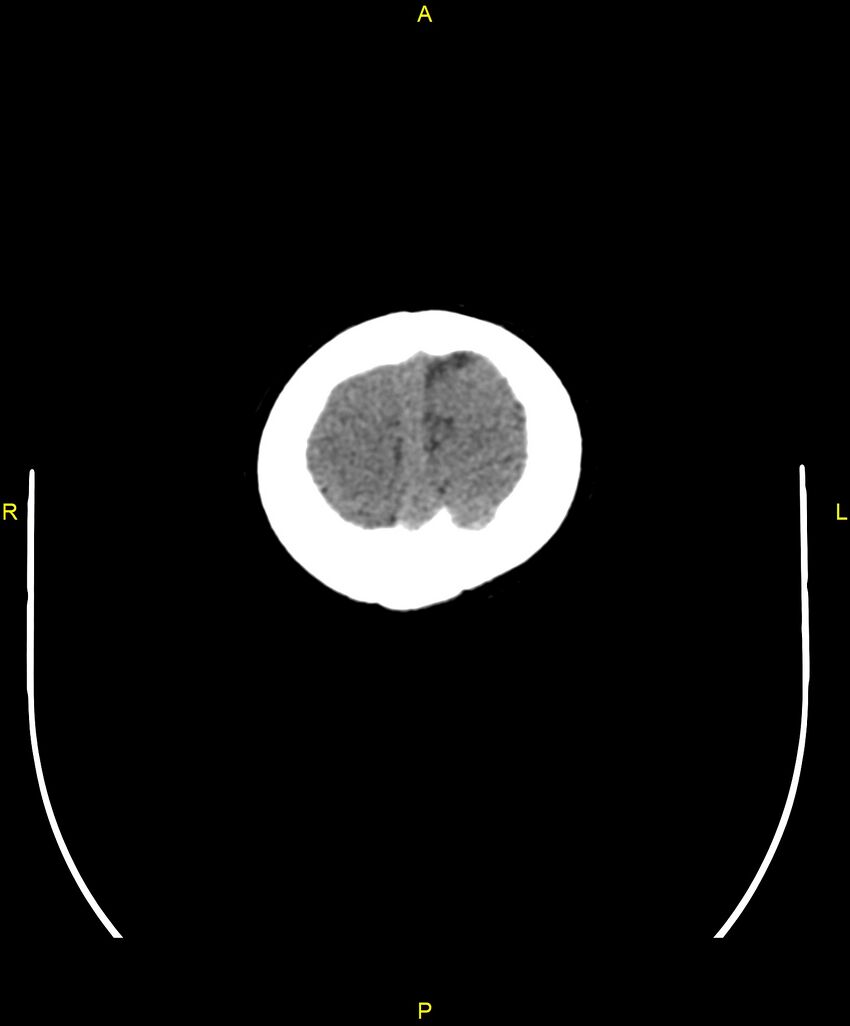 Choroidal fissure cyst (Radiopaedia 89481-106465 Axial non-contrast 114).jpg