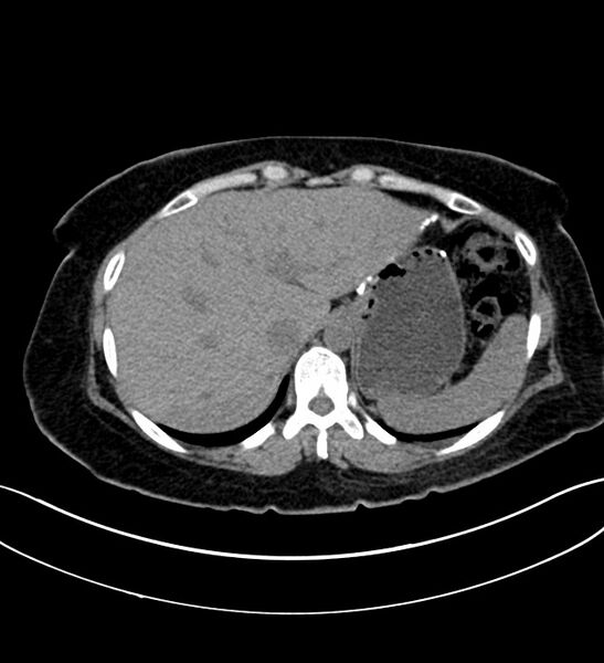 File:Chromophobe renal cell carcinoma (Radiopaedia 84290-99582 Axial non-contrast 28).jpg