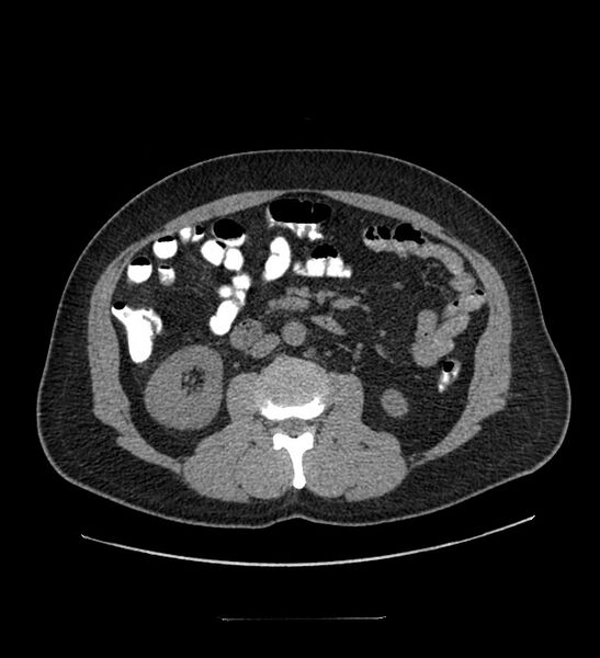 File:Chromophobe renal cell carcinoma (Radiopaedia 84337-99644 Axial non-contrast 51).jpg