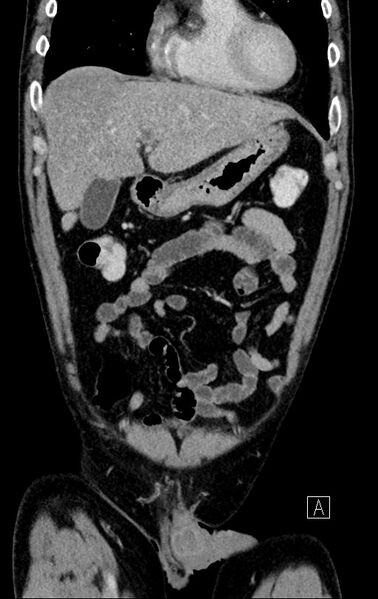 File:Chronic appendicitis complicated by appendicular abscess, pylephlebitis and liver abscess (Radiopaedia 54483-60700 C 22).jpg
