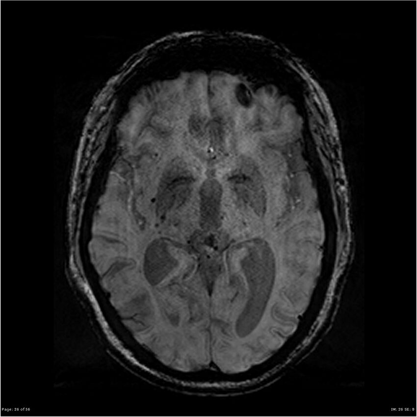 Chronic hypertensive encephalopathy (Radiopaedia 25764-25918 Axial SWI 26).jpg