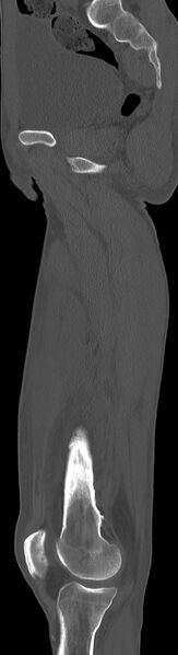 File:Chronic osteomyelitis (with sequestrum) (Radiopaedia 74813-85822 C 66).jpg