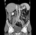 Chronic pancreatitis (Radiopaedia 23132-23172 C 33).jpg