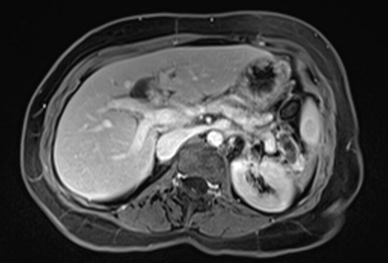 File:Chronic pancreatitis - pancreatic duct calculi (Radiopaedia 71818-82250 Axial T1 C+ fat sat 23).jpg