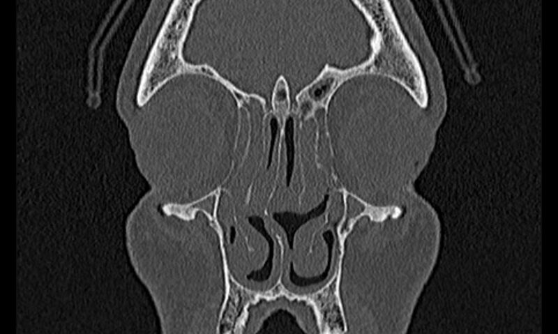 File:Chronic rhinosinusitis (Radiopaedia 65079-74075 Coronal bone window 19).jpg