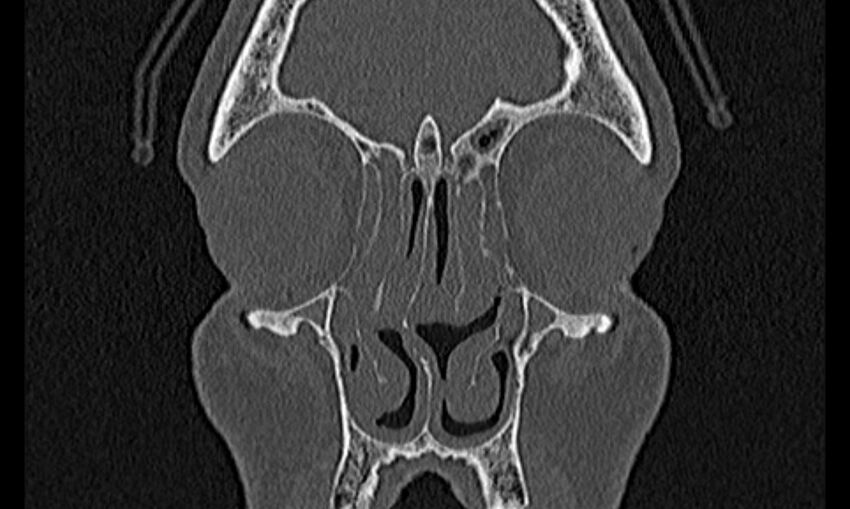 Chronic rhinosinusitis (Radiopaedia 65079-74075 Coronal bone window 19).jpg