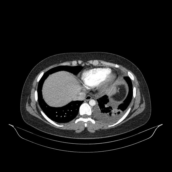 File:Chronic thromboembolic pulmonary hypertension (CTEPH) (Radiopaedia 74597-85532 Axial C+ CTPA 42).jpg