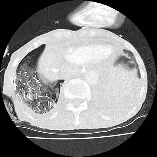 File:Clagett thoracotomy with bronchopleural fistula (Radiopaedia 29192-29587 Axial lung window 43).jpg