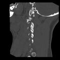 Clay-shoveler fracture (Radiopaedia 22568-22590 Sagittal bone window 4).jpg