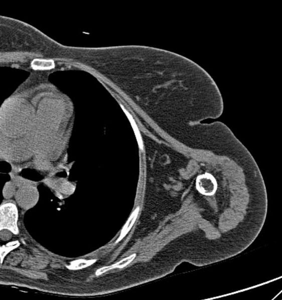 File:Clear cell chondrosarcoma - humerus (Radiopaedia 63104-71612 Axial non-contrast 76).jpg