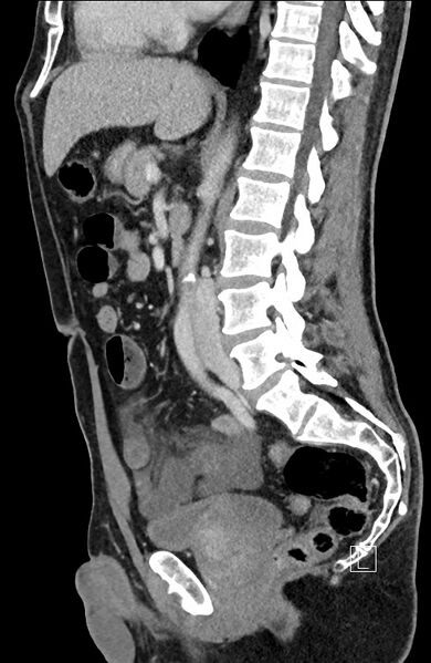 File:Closed loop small bowel obstruction - internal hernia (Radiopaedia 57806-64778 C 59).jpg