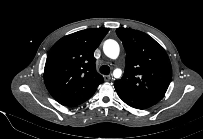 File:Coarctation of aorta with aortic valve stenosis (Radiopaedia 70463-80574 A 50).jpg
