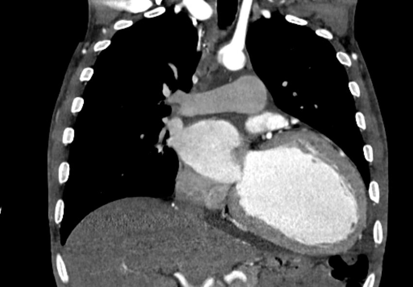 Coarctation of aorta with aortic valve stenosis (Radiopaedia 70463-80574 C 101).jpg