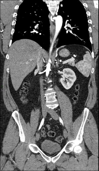 File:Coarctation of the aorta (Radiopaedia 74632-88521 B 136).jpg