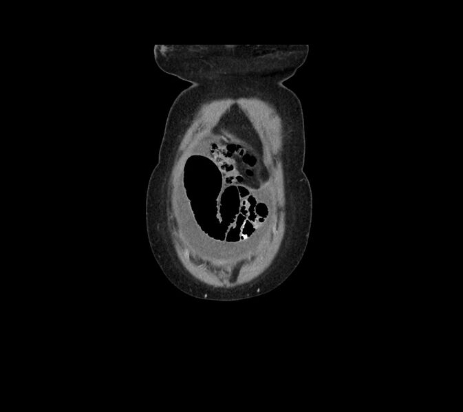 File:Cocoon abdomen with possible tubo-ovarian abscess (Radiopaedia 46235-50636 B 4).jpg
