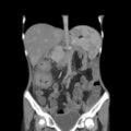 Colocolic fistula - Crohn disease (Radiopaedia 57063-63955 B 20).jpg