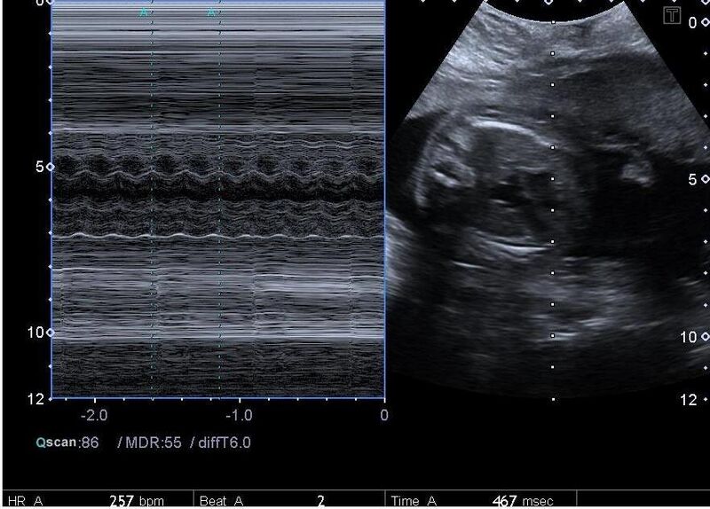 File:Fetal supraventricular tachycardia (Radiopaedia 37079).jpg