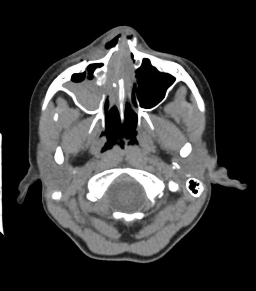 File:Nasoorbitoethmoid fracture (Radiopaedia 90044-107205 Axial non-contrast 128).jpg