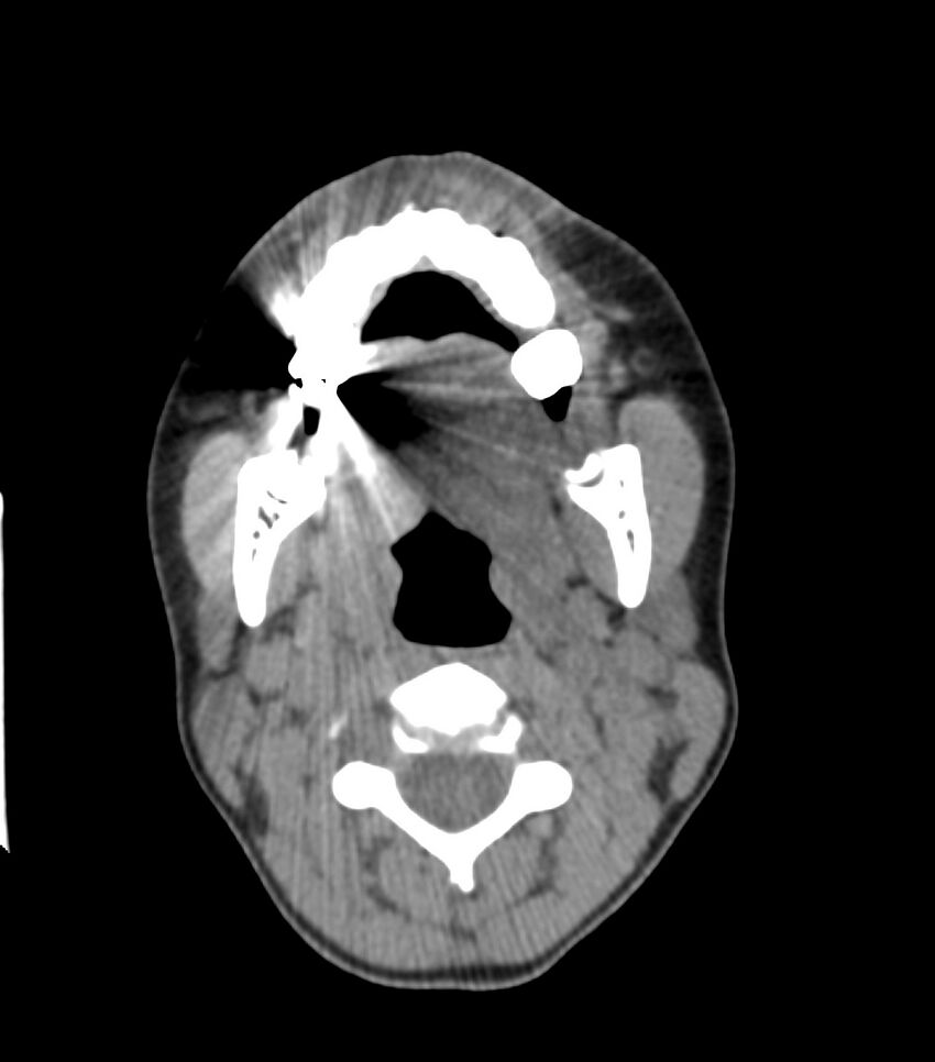 Nasoorbitoethmoid fracture (Radiopaedia 90044-107205 Axial non-contrast 82).jpg