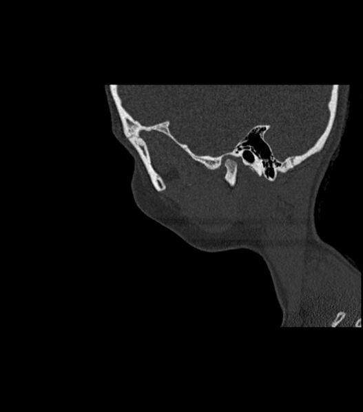File:Nasoorbitoethmoid fracture (Radiopaedia 90044-107205 Sagittal bone window 29).jpg
