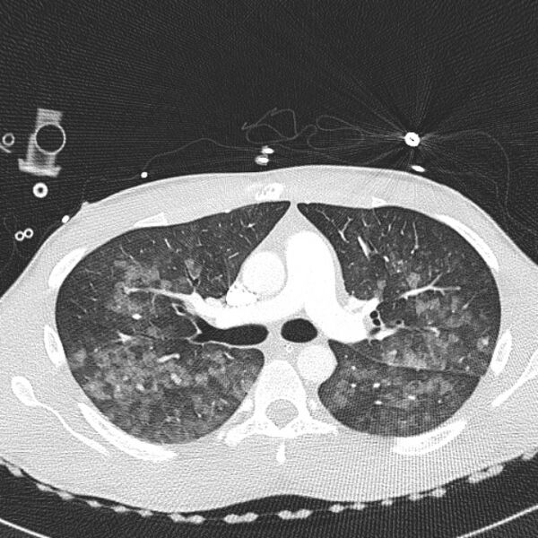 File:Near drowning (pulmonary edema) (Radiopaedia 24685-24958 lung window 15).jpg