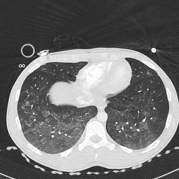 File:Near drowning (pulmonary edema) (Radiopaedia 24685-24958 lung window 65).jpg