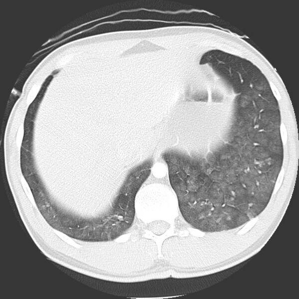 File:Near drowning pulmonary edema (Radiopaedia 16868-16591 Axial lung window 47).jpg