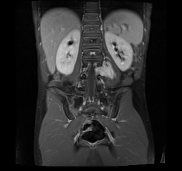 File:Neuroblastoma (Radiopaedia 6010-7518 Coronal T1 fat sat 1).jpg