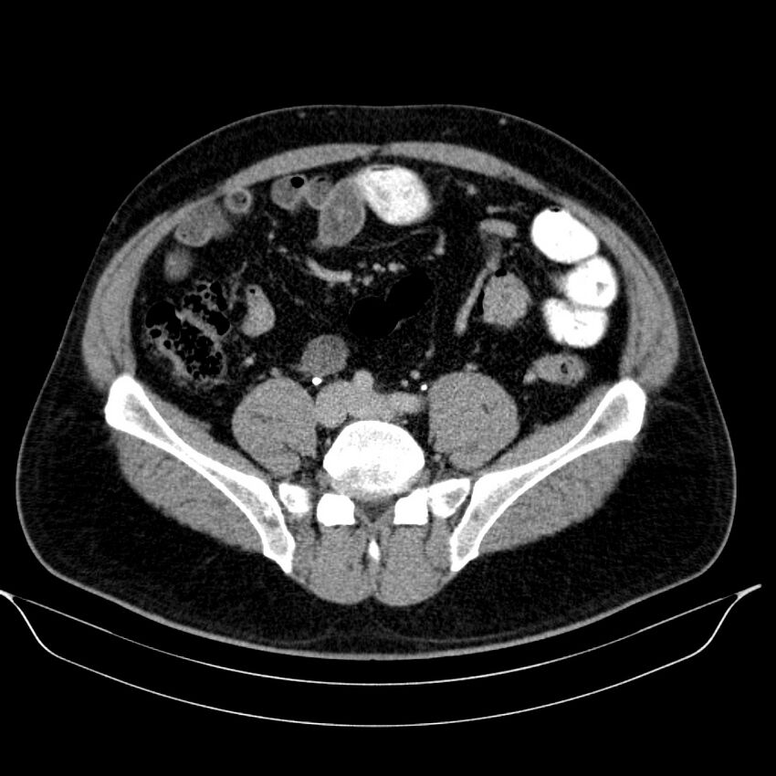 Neuroendocrine tumor of head of pancreas (Radiopaedia 57538-64502 D 58).jpg