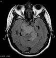 Neurofibromatosis type 2 - cranial and spinal involvement (Radiopaedia 5351-7111 Axial FLAIR 1).jpg