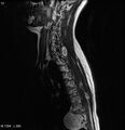 Neurofibromatosis type 2 - cranial and spinal involvement (Radiopaedia 5351-7112 Sagittal T2 9).jpg
