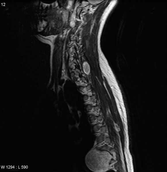 File:Neurofibromatosis type 2 - cranial and spinal involvement (Radiopaedia 5351-7112 Sagittal T2 9).jpg