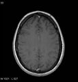 Neurosarcoidosis (Radiopaedia 10930-11351 Axial T1 C+ 14).jpg