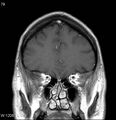 Neurosarcoidosis (Radiopaedia 10930-17204 Coronal T1 C+ 3).jpg
