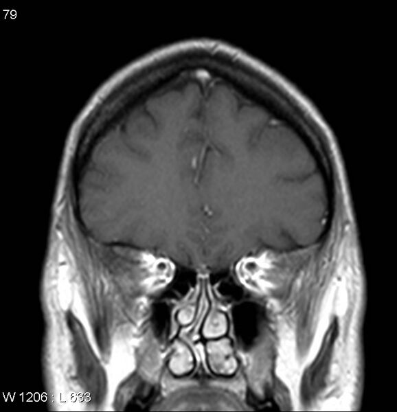 File:Neurosarcoidosis (Radiopaedia 10930-17204 Coronal T1 C+ 3).jpg