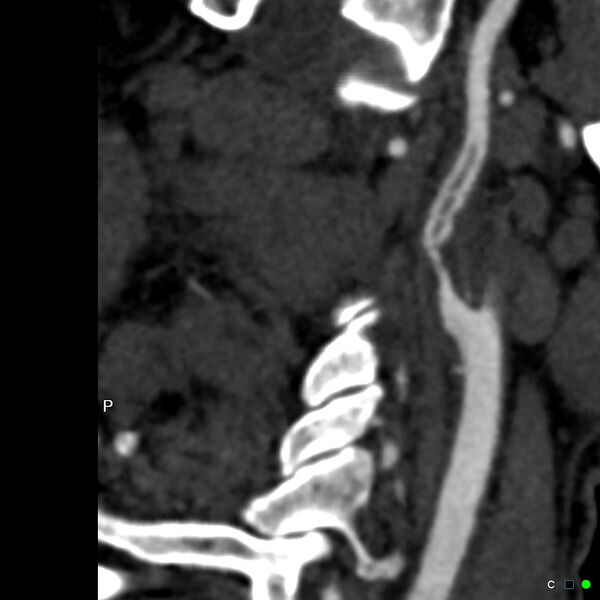 File:Non-occlusive intraluminal internal carotid artery thrombus (Radiopaedia 37751-39658 A 24).jpg