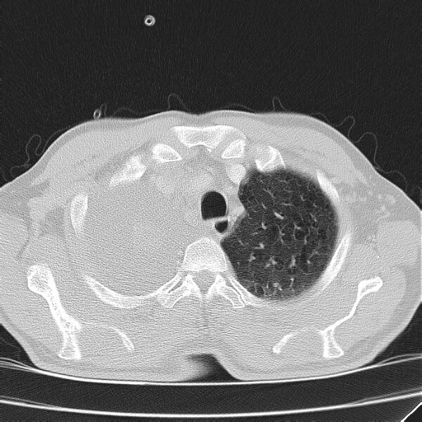 File:Non small-cell lung cancer (Radiopaedia 24467-24769 lung window 7).jpg