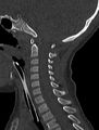 Normal CT cervical spine - pediatric (Radiopaedia 52549-58462 Sagittal bone window 92).jpg